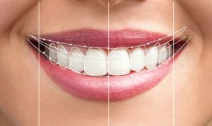 تفاوت لمینت سرامیکی با کامپوزیت وینر
